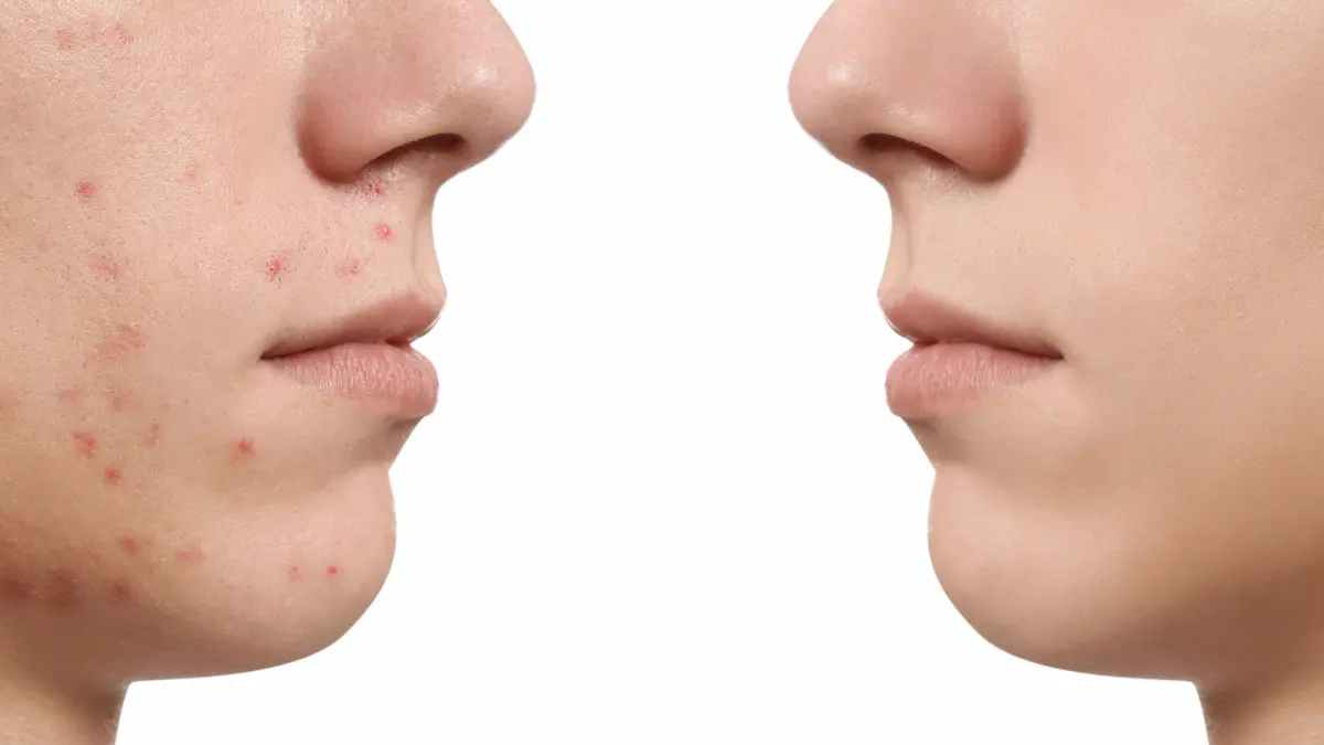 Rosto com acne